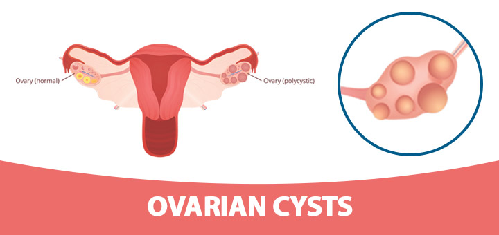 Ovarian-Cysts