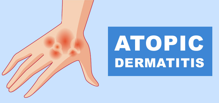 atopic-dermatitis